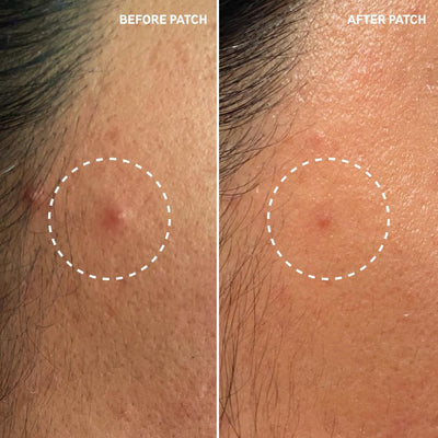 INKEY Hydrocolloid Invisible Pimple Patches + Salicylic Acid