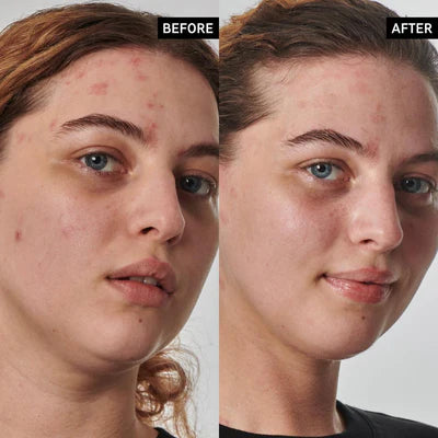 INKEY SuperSolutions 10% Urea Moisturizer Textured Skin Solution